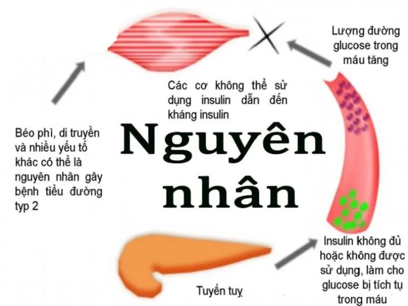 Nguyên nhân gây ra bệnh tiểu đường