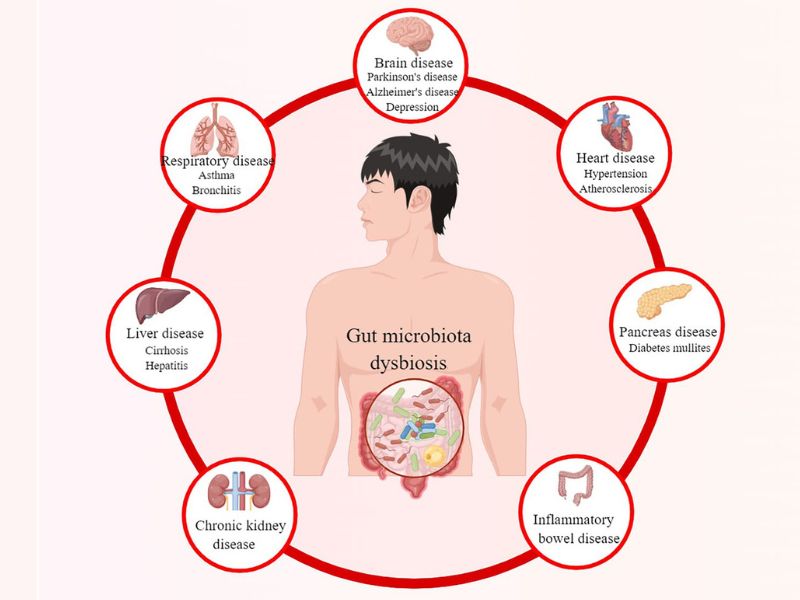 Vai trò của hệ vi sinh vật đường ruột trong sinh lý bệnh và điều trị bệnh đái tháo đường