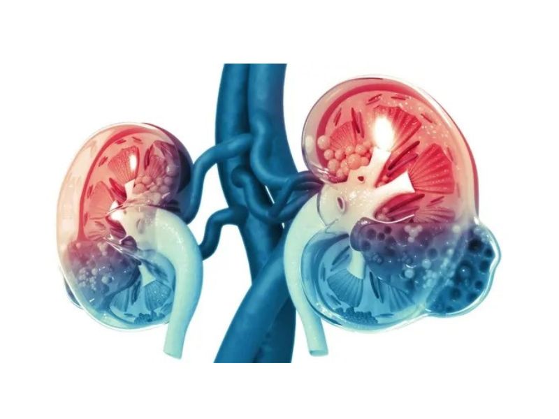 Tổn thương thận hai bên